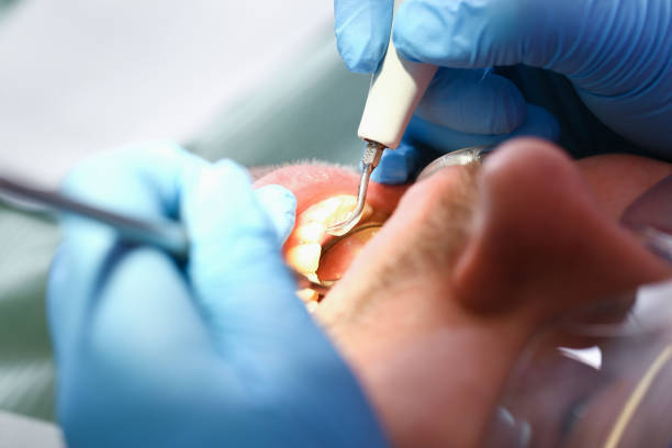 Best Broken or Chipped Tooth Repair in Macom, IL