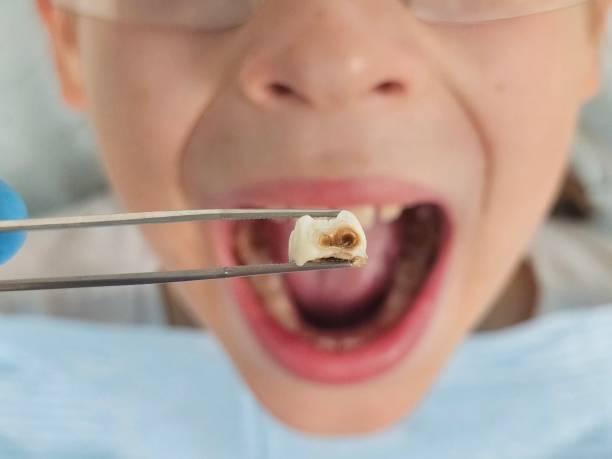 Best Emergency Root Canal Therapy in Macom, IL